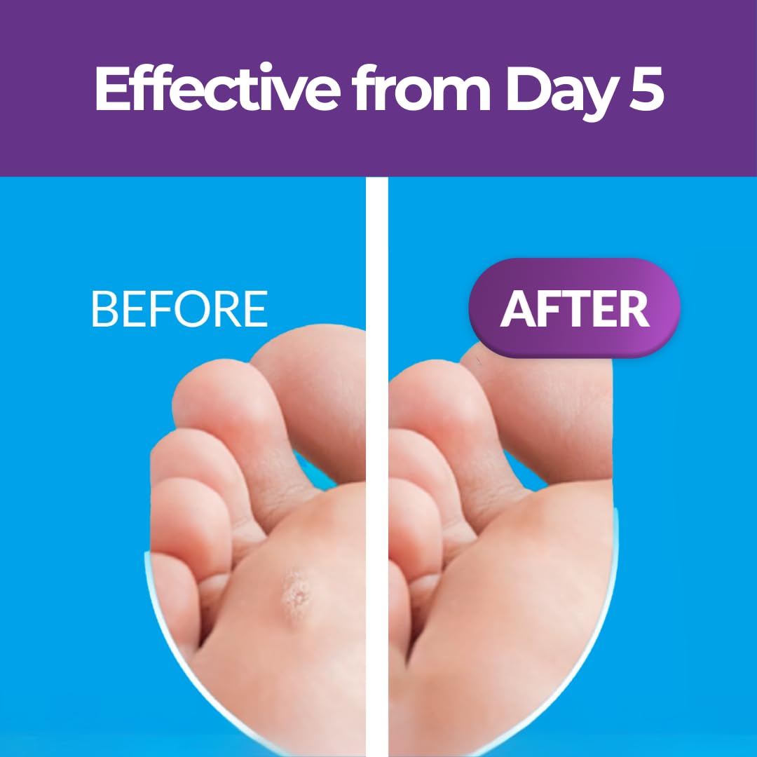 Excilor Warts Duo Power Treatment - Extra Strong Effective Wart Verruca Removal - 2 Devices in 1 Box - Cryo Freeze & Acid Treatment - Hands & Feet - Effective from Day 5 - Clinically Proven