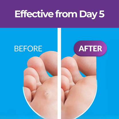 Excilor Warts Duo Power Treatment - Extra Strong Effective Wart Verruca Removal - 2 Devices in 1 Box - Cryo Freeze & Acid Treatment - Hands & Feet - Effective from Day 5 - Clinically Proven