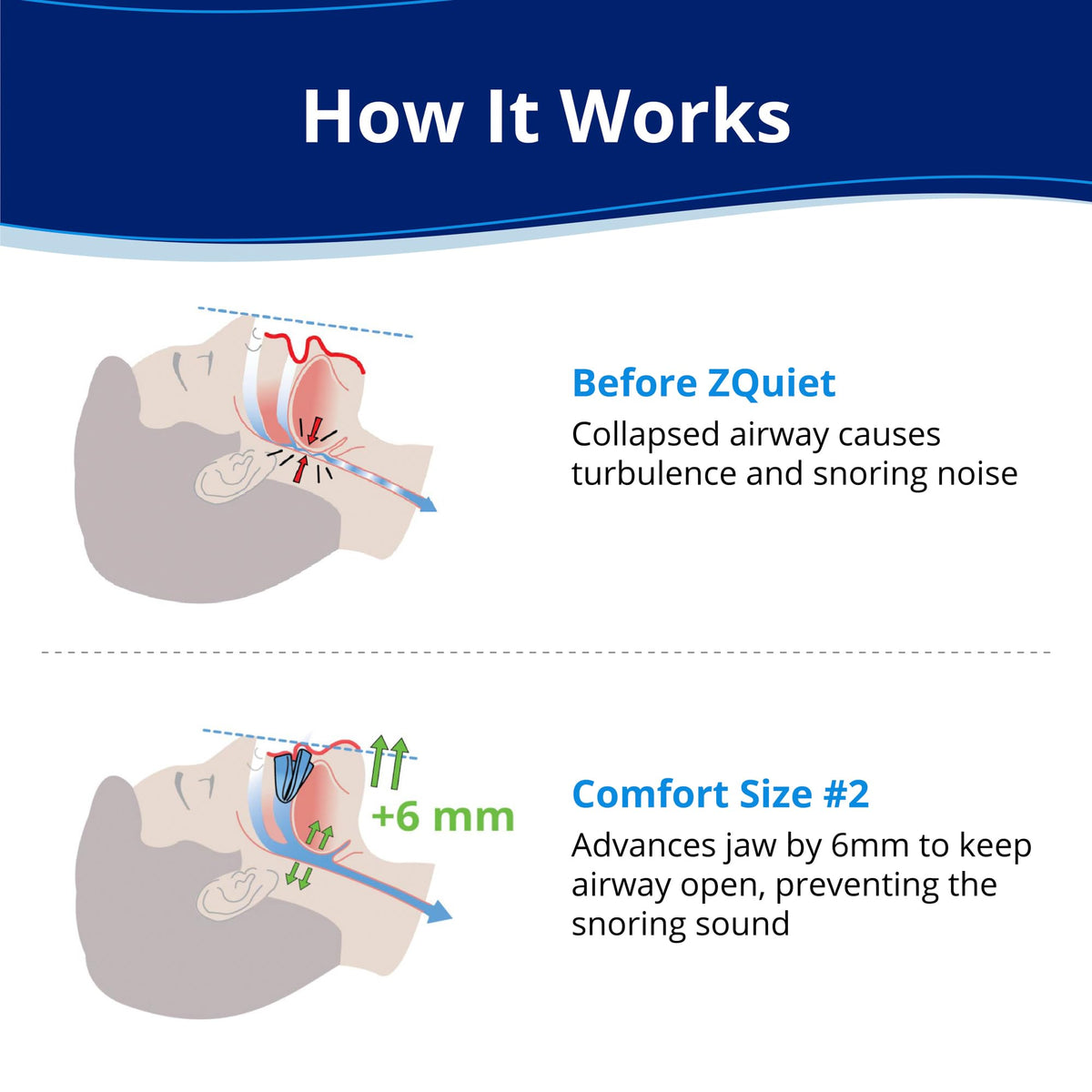 ZQuiet, Anti-Snoring Mouthpiece, Comfort Size #2, Single Refill, Blue Made in USA, BPA-Free, Medical-Grade Material