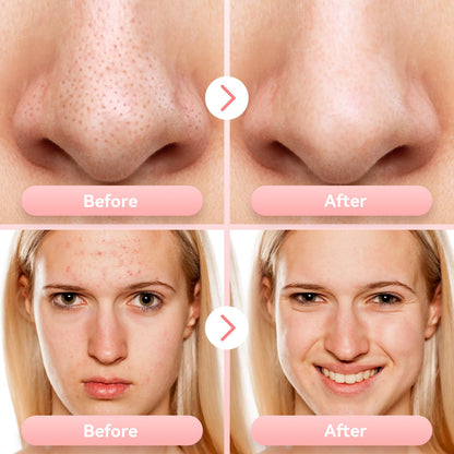 Blackhead Remover Pore Vacuum Upgraded Facial Pore Cleaner Electric Comedone Whitehead Extractor Tool-USB Rechargeable Blackhead Vacuum Kit for Women & Men
