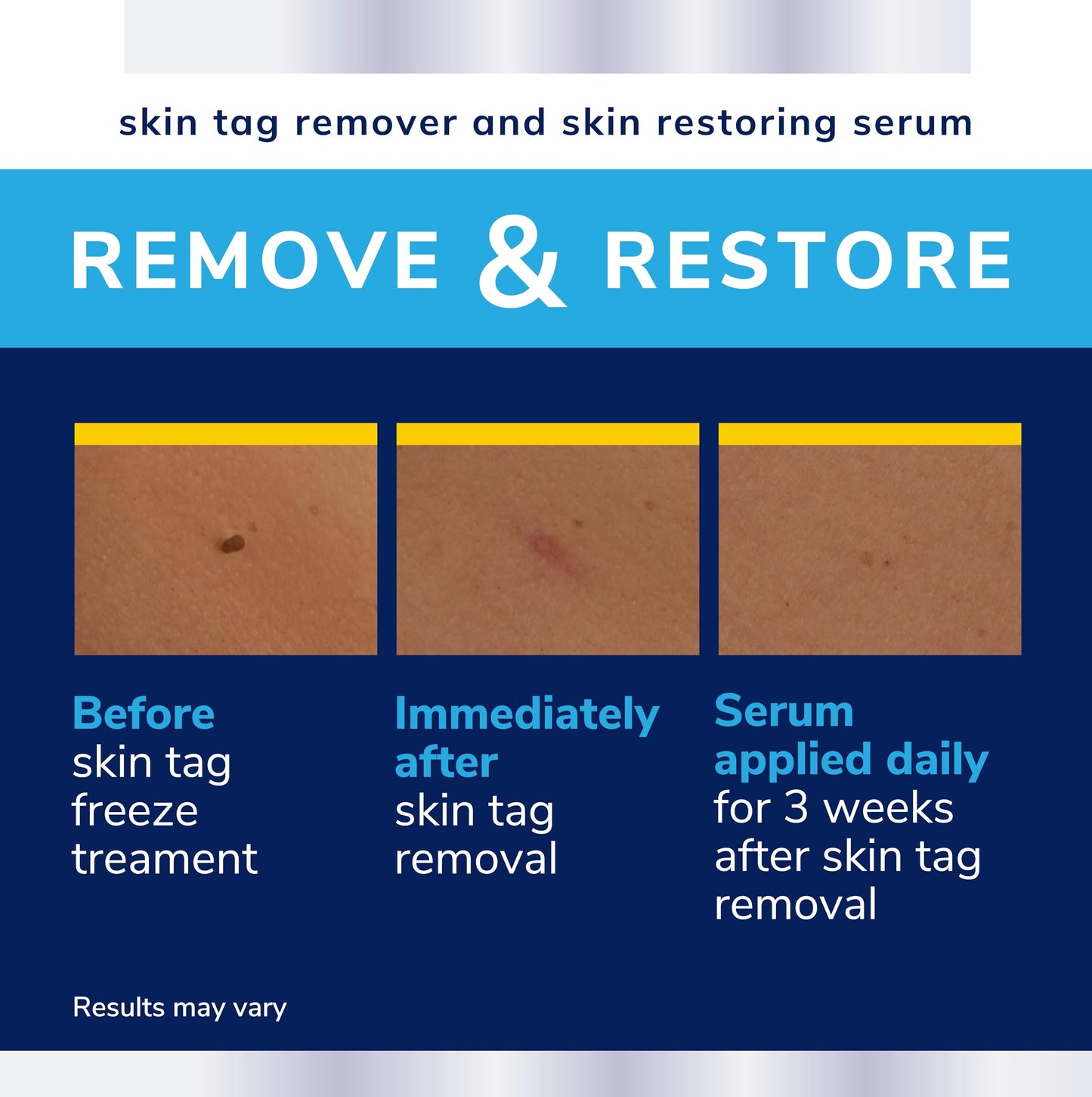 Scholl Complete Care Skin Tag Removal Kit - Safe & Effective Skin Tag Remover - Moisturising Serum Restores Skin's Appearance - Clinically Proven - 12 Treatments Plus Hydrating Serum