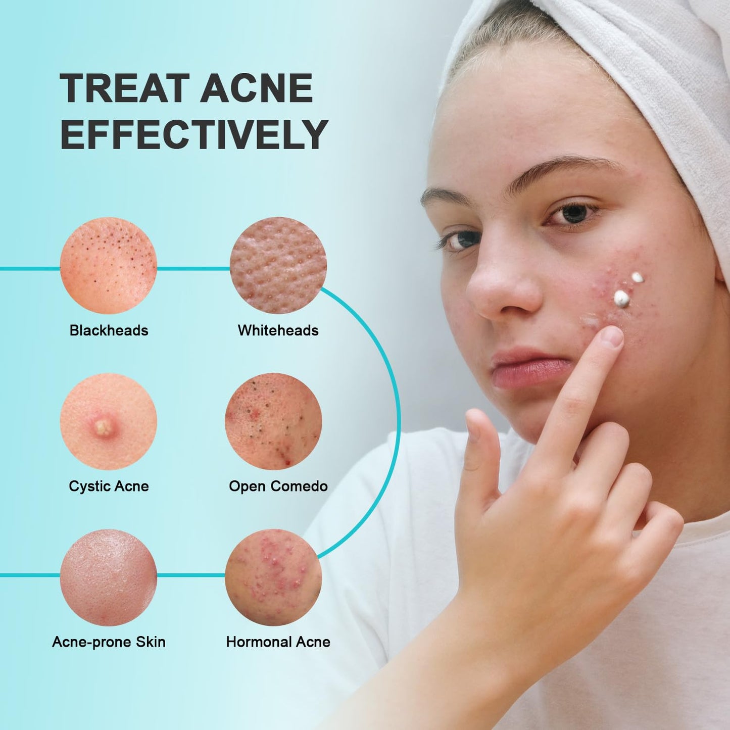 Acne Pimple Spot Treatment Cream: Cystic Hormonal Blackheads Blemish Remover for Face, Back and Body - with 10% Azelaic Acid - Teens 13-19 & Young Adult 20-30, 1.8 oz
