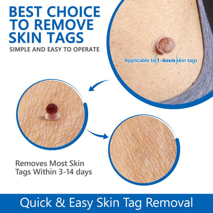 Skin Tag Removal - Auto Skin Tag Remover Pen Kit with 60 Micro and Regular Skin Tag Bands, Fast and Easy Remover Wart and Mole(1mm-9mm), for Face and Body, with 36 Skin Tag Removal Repair Patches