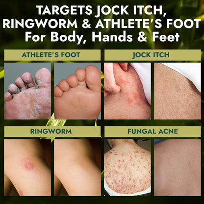 Antifungal Soap | Medicated Jock Itch Treatment, Fights Ringworm & Athlete's Foot | Soothing Tea Tree & Eucalyptus | 1% Tolnaftate for Effective Relief | Travel-Friendly with Soap Case
