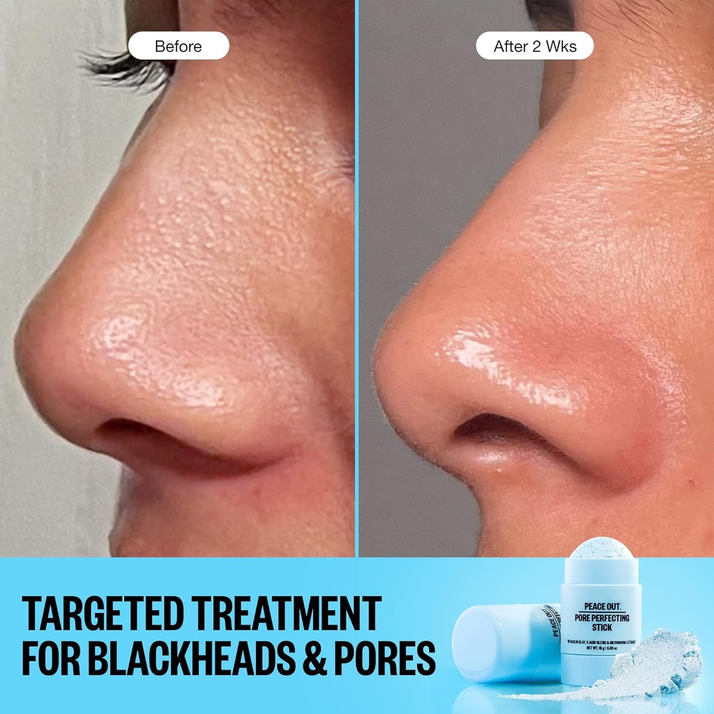 PEACE OUT Pore Perfecting Stick Acne Solution & Blackhead Remover, Glycolic Acid & Salicylic Acid Cleanser, Works Like a Face Wash, Skincare Facial Cleanser & Exfoliating Facial Scrub, 15g /0.53oz